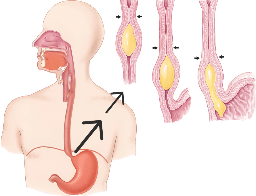 Achalasia