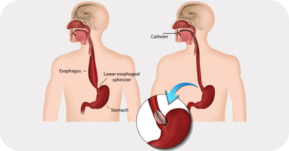 What is Achalasia?