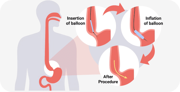 Treatment Options for Achalasia