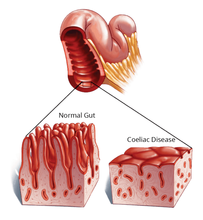 coeliac disease