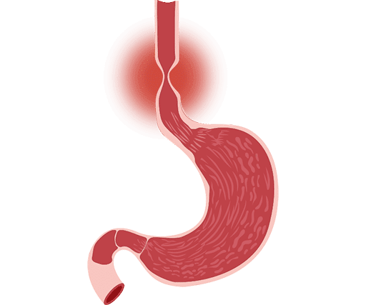 Eosinophilic Oesophagitis Treatment