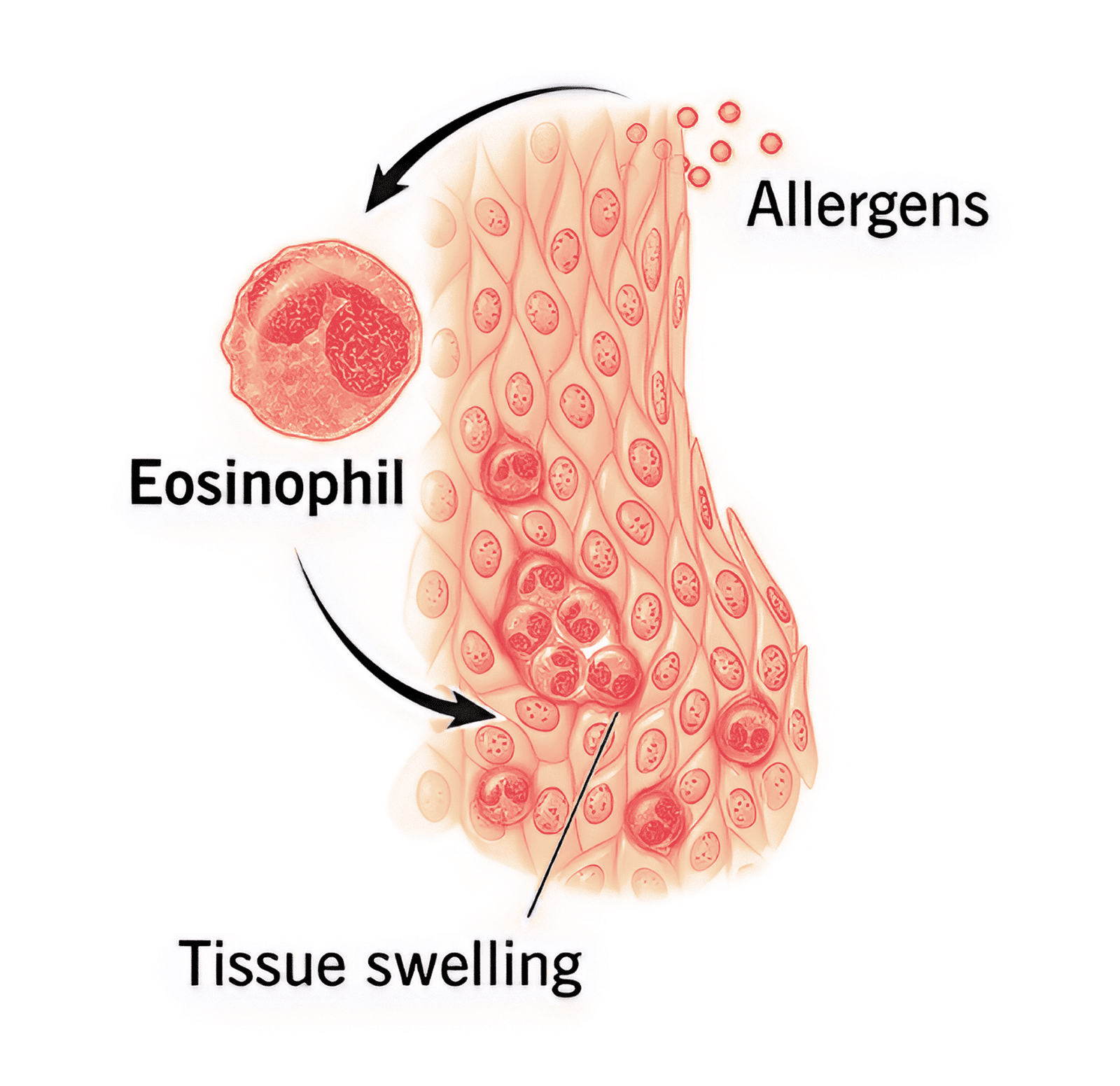 Eosinophilic Oesophagitis