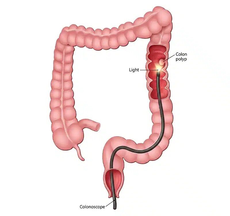 Medical illustration of a colonoscopy procedure showing a colonoscope with light examining the large intestine and identifying a colon polyp, helping explain Bowel Cancer screening and early detection.