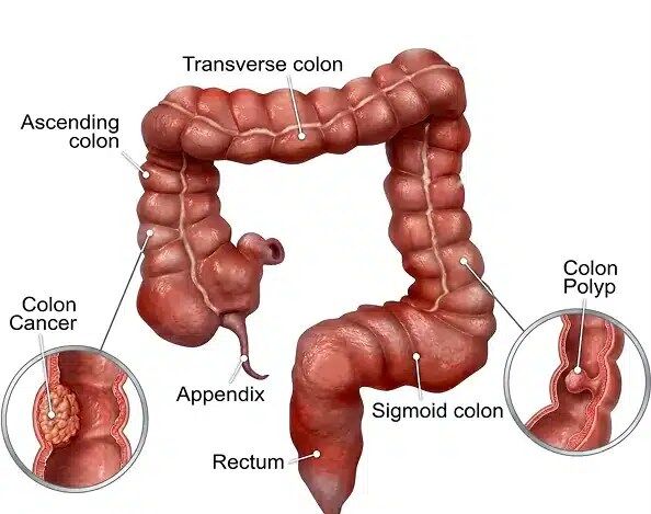 Illustration of the large intestine showing the ascending colon, transverse colon, sigmoid colon, rectum, appendix, colon polyp, and colon cancer area, used to explain Bowel Cancer development and symptoms.