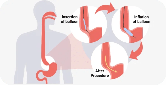 Treatment Options for Achalasia