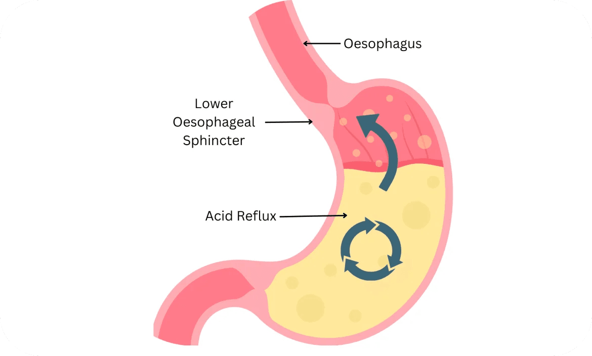 Factors leading to Barrett's Oesophagus?