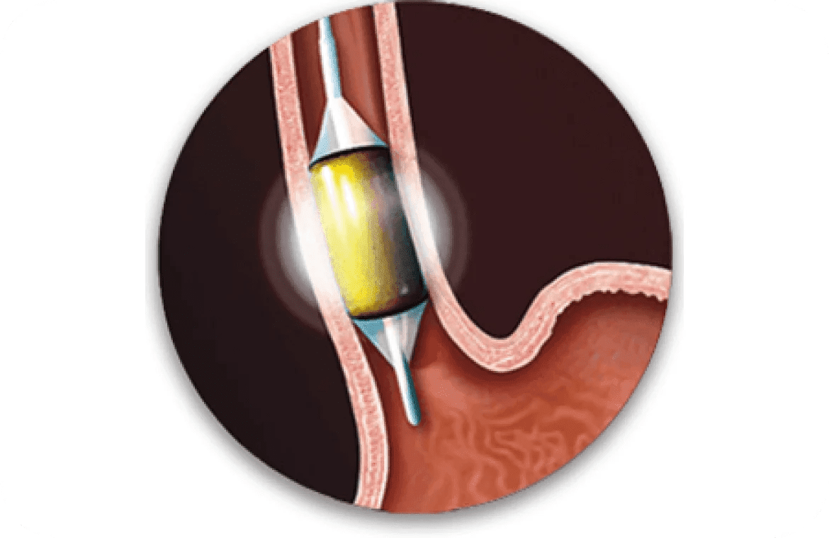 Radio Frequency Ablation (RFA)