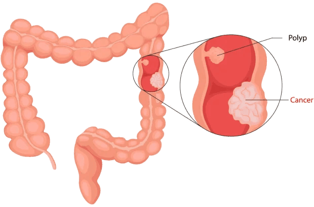 bowel cancer