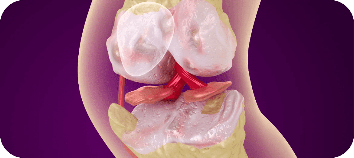 Avoiding Complications of Coeliac Disease