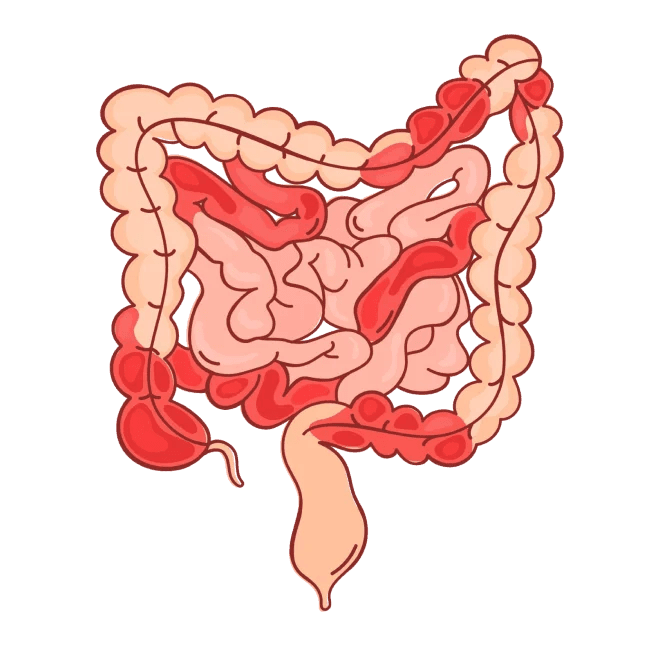 Crohn’s disease