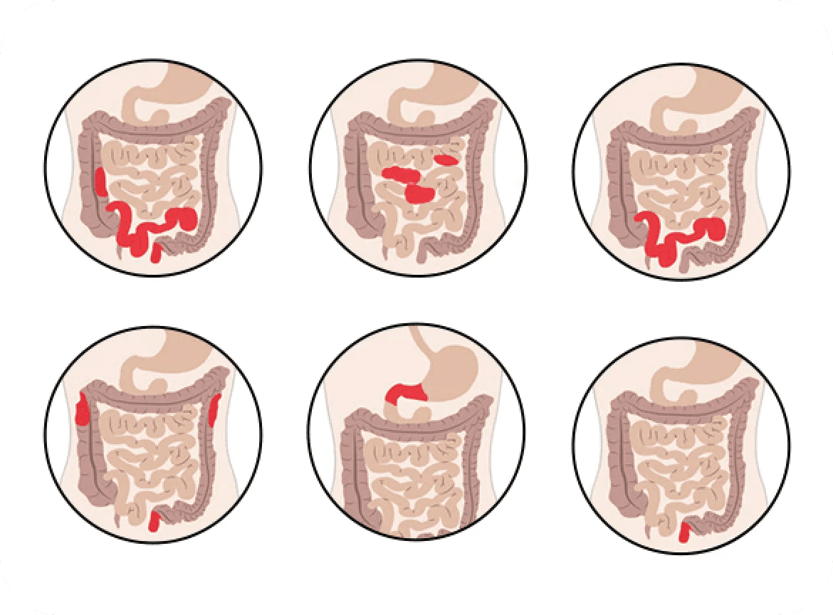 Types of Crohn’s Disease