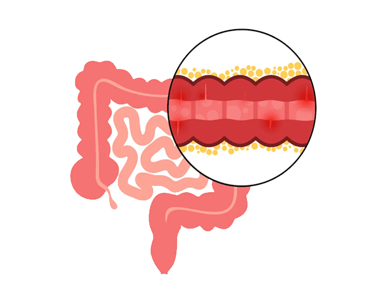 Understanding Crohn’s Disease