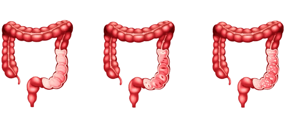 Types of Constipation