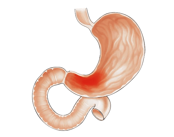 Causes of Functional Dyspepsia