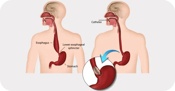 What is Achalasia?