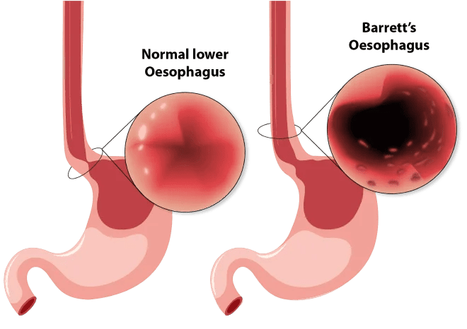 Barretts Oesophagus
