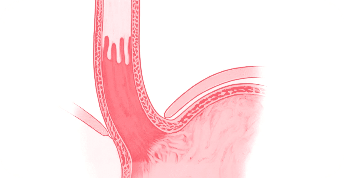 What is Barrett’s Oesophagus?